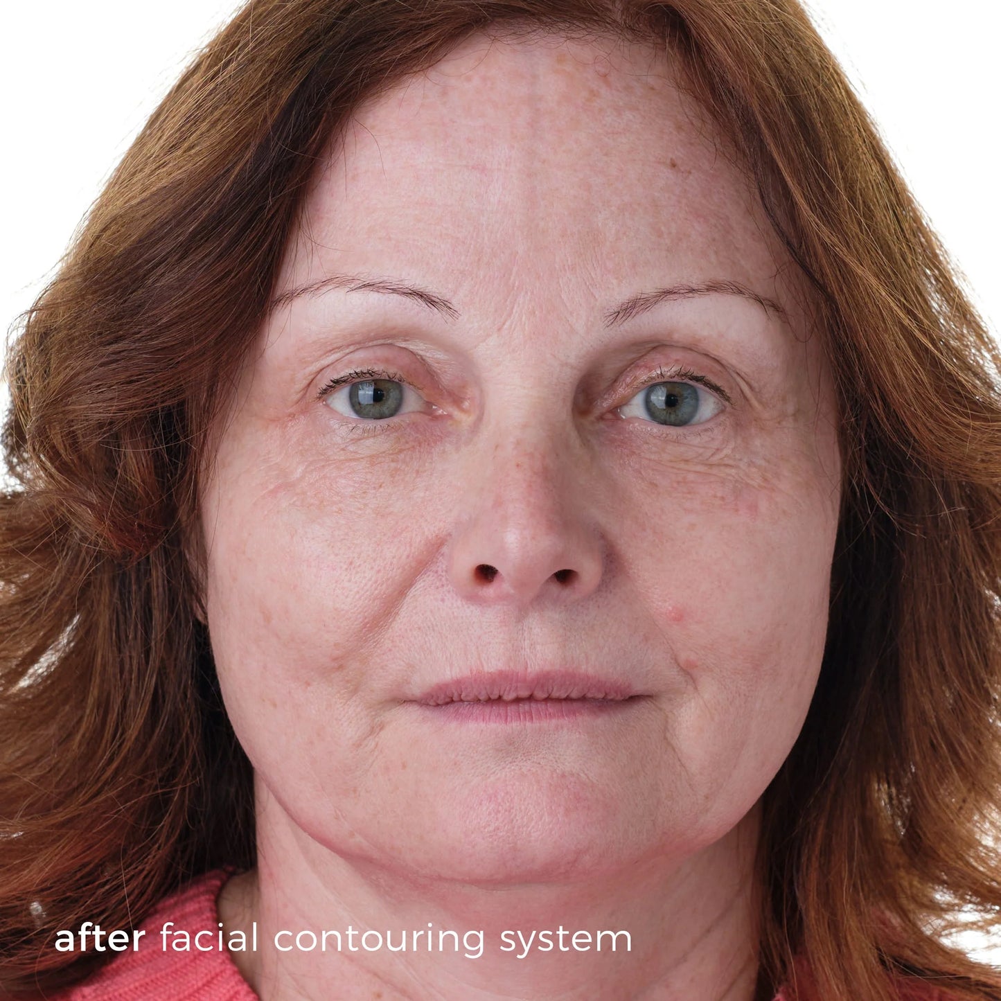 SkinBunny Facial Contouring System - 5 Treatments