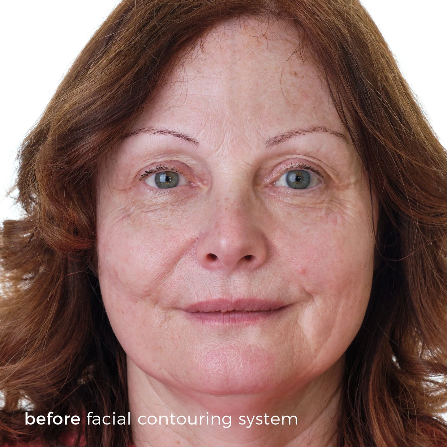 SkinBunny Facial Contouring System - 5 Treatments